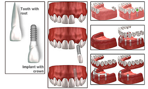 Dental Implants examples