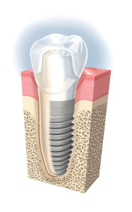 How Inexpensive Can Dental Implants Be