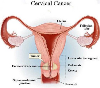 Cervical Cancer Stages explanation in details
