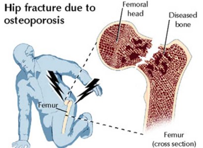 Osteoporosis problems for older people