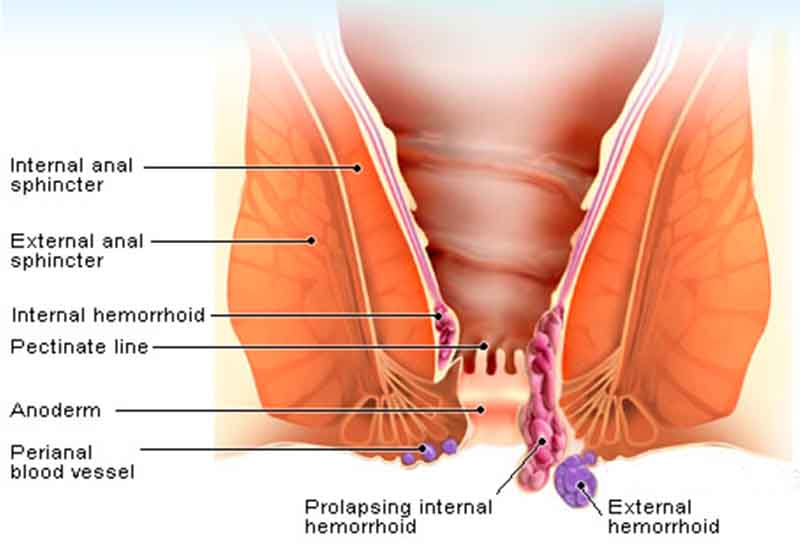 Hemorrhoid Symptoms know the signs so that you can fight back