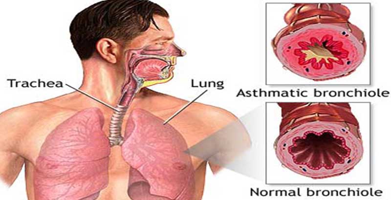 Asthma Homeopathy - Herbal Supplements For Asthma