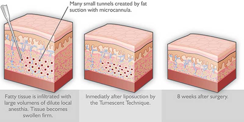 Liposuction More than Just a Thigh Helper